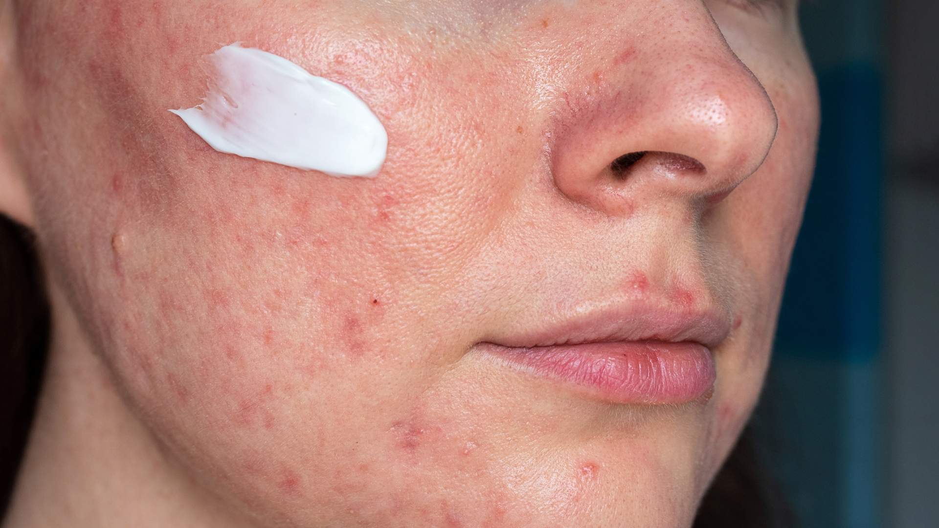 rosacea